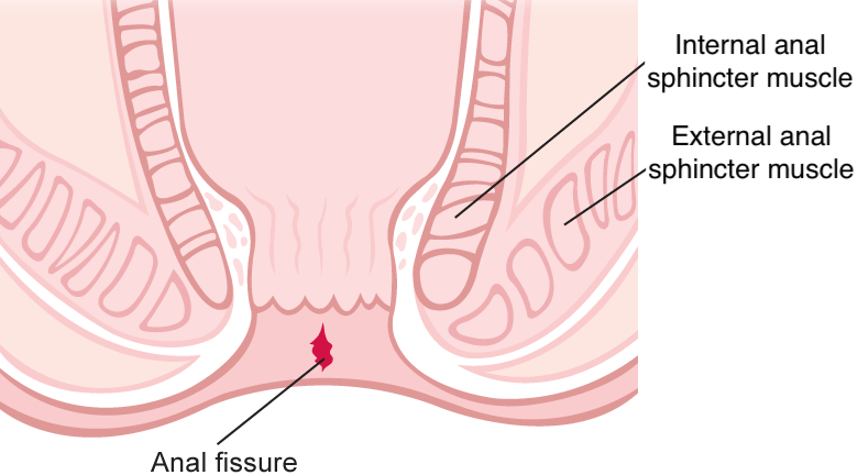 Anal Fissure Diagram